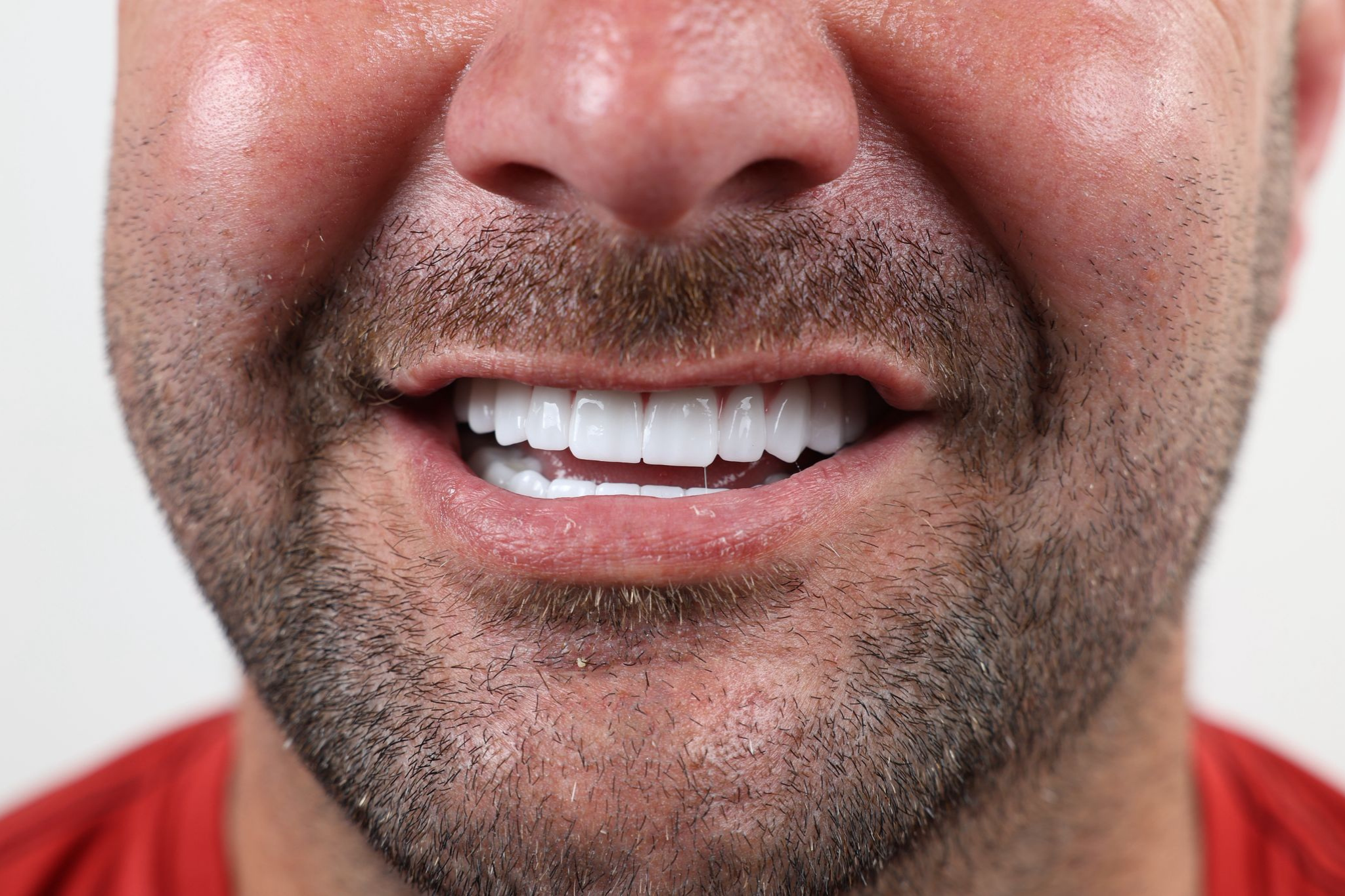 After All-on-6 Implant Treatment